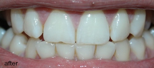 After Smile Brilliant LED Teeth Whitening Kit